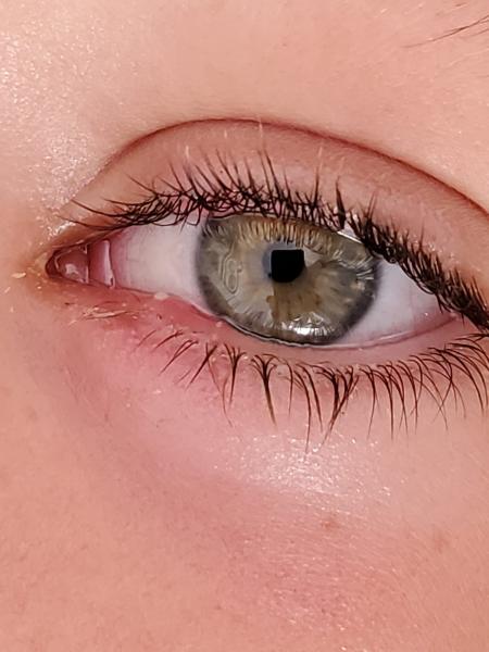 Oftalmólogos en Torrevieja Alicante. Clínica oftalmológica en la Vega Baja. Eye Clinic. Oculista en Torrevieja. Ojo con conjuntivitis coronavirus