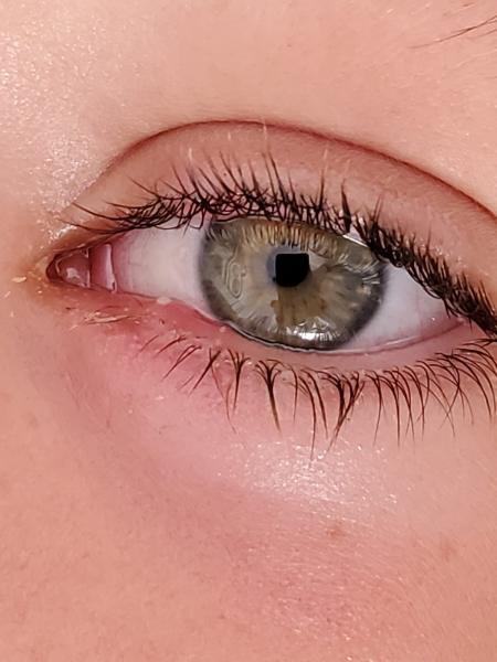 Ojo con conjuntivitis coronavirus 