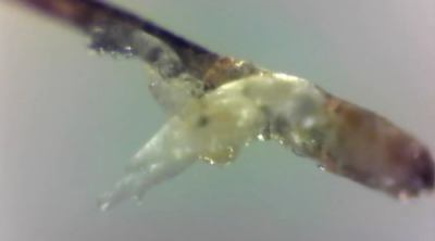 Oftalmólogos en Callosa del Segura (Alicante) imagen del demodex parásito en pacientes con Blefaritis. Tratamiento para eliminar el parásito que afecta a las pestañas de los ojos. Clínica oftalmológica en Orihuela. Torrevieja. Vega Baja. Almoradí. Rojales. Ciudad Quesada.