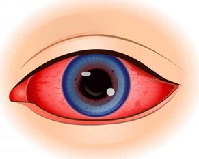 Que es la uveítis como enfermedad ocular, como se puede curar la uveítis, donde puedes encontrar una clinica oftalmológica en torrevieja o la vega baja, clinica oftalmológica en guardamar del segura, en orihuela, en alicante, en elche, en santa pola, en daya vieja y daya nueva. Visionker - Eye clinic Torrevieja