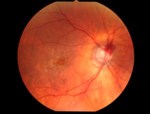 Clínica de oftalmología en TORREVIEJA - ALICANTE Tratamiento GLAUCOMA Visita, diagnóstico y tratamiento del glaucoma. Tratamiento DMAE Visita, diagnóstico y tratamiento de DMAE Tratamiento DESPRENIDMIENTO DE RETINA Visita, diagnóstico y tratamiento quirúrgico de desprendimiento de retina Tratamiento AGUJERO MACULAR Visita, diagnóstico y tratamiento de agujero macular Tratamiento RETINOPATÍA DIABÉTICA Visita, diagnóstico y tratamiento médico de retinopatía diabética Tratamiento MEMBRANAS EPIRRETINIANAS Visita, diagnóstico y tratamiento quirúrgico de membranas epirretinianas Tratamiento CATARATA Visita, diagnóstico y tratamiento quirúrgico de catarata Tratamiento LASIK Visita, diagnóstico y tratamiento quirúrgico de LASIK Tratamiento PRK Visita, diagnóstico y tratamiento quirúrgico de PRK Tratamiento OJO SECO Visita, diagnóstico y tratamiento de ojo seco Tratamiento BLEFARITIS Visita, diagnóstico y tratamiento de blefaritis Tratamiento CUERPO EXTRAÑO Visita, diagnóstico y tratamiento de cuerpo extraño Tratamiento ENTROPIÓN / ECTROPIÓN Visita, diagnóstico y tratamiento quirúrgico de entropión y ectropión Tratamiento BLEFAROPLASTIA Visita, diagnóstico y tratamiento quirúrgico de blefaroplastia Tratamiento RELLENOS ÁCIDO HIALURÓNICO Visita, diagnóstico y tratamientos de relleno de labios, ojeras, etc Tratamiento BOTOX Visita, diagnóstico y tratamiento de toxina botulínica (BOTOX) Tratamiento FOTOREJUVENECIMIENTO Visita, diagnóstico y tratamiento de fotorejuvencimiento Tratamiento PEELINGS FACIALES Visita, diagnóstico y tratamiento con peelings faciales Tratamiento MESOTERAPIA Visita, diagnóstico y tratamiento con mesoterapia Tratamiento HILOS TENSORES Visita, diagnóstico y tratamiento con hilos tensores EXAMEN OPTOMÉTRICO Medida de la agudeza visual y refracción, toma de la presión intraocular con tonómetro de aire y análisis de segmento anterior LENTES DE CONTACTO Visita, adaptación de lentes de contacto TERAPIA VISUAL Visita, terapia visual Torrevieja Orihuela Pilar de la Horadada Almoradí Callosa de Segura Rojales Guardamar del Segura Albatera Catral Redován San Fulgencio Dolores Cox Bigastro San Miguel de Salinas Benejúzar Los Montesinos Rafal Formentera del Segura Benijófar Algorfa Granja de Rocamora Jacarilla San Isidro Benferri Daya Nueva Daya Vieja