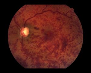 VISIONKER está compuesta por oftalmólogos y optometristas con un alto grado de especialización en las distintas patologías oculares, todos ellos con una excelente trayectoria profesional y científica. Nuestra misión es dar una solución personalizada y eficaz a los problemas visuales de nuestros pacientes, crear y consolidar un centro de excelencia a nivel nacional en la prevención y curación de las enfermedades oculares y en la aplicación de nuevos tratamientos. Se trata de una instalación moderna, actual y amplia con equipamiento para diagnóstico de vanguardia. Ofrecemos soluciones a los problemas y enfermedades oculares mediante tratamiento médico o quirúrgico, con un enfoque integral, y buscando la máxima calidad asistencial a través de una atención personalizada.